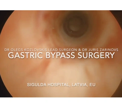 GASTRIC BYPASS RNY VIDEO, FULL SURGERY